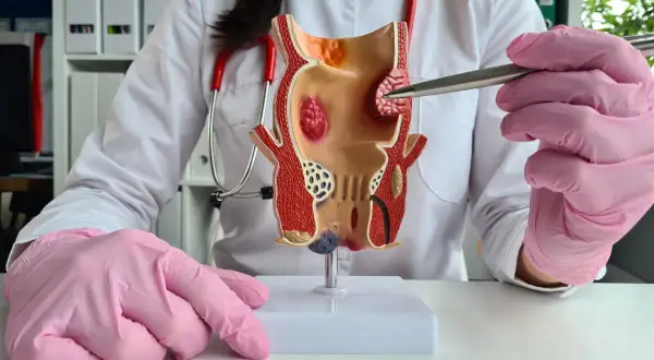 Model jelita grubego z widocznymi zmianami, wskazującymi na hemoroidy zewnętrzne.