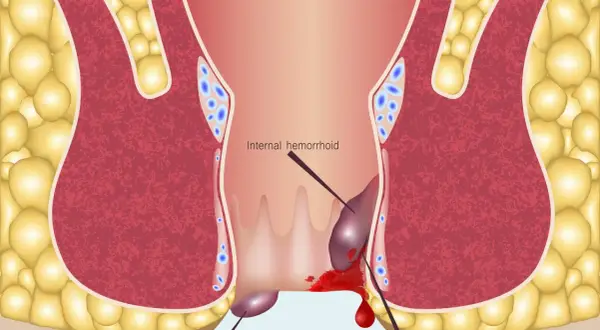 Ilustracja anatomiczna hemoroidów wewnętrznych z krwawieniem.