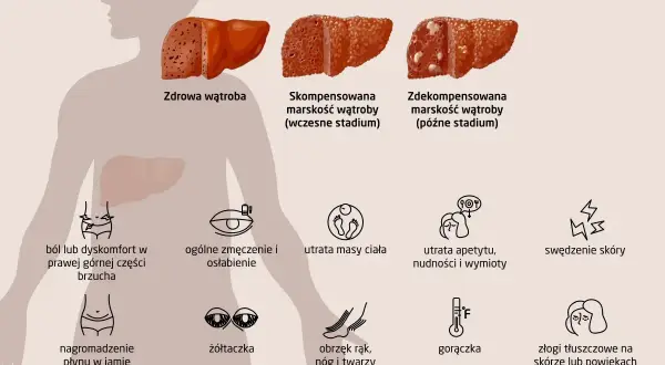 Marskość wątroby: Objawy końcowego stadium co musisz wiedzieć?
