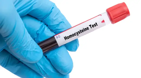 Rękawiczka medyczna trzyma probówkę z krwią do badania. Etykieta na probówce informuje: "Homocysteina Test". Badanie homocysteiny co to jest, pomoże ocenić ryzyko chorób serca.