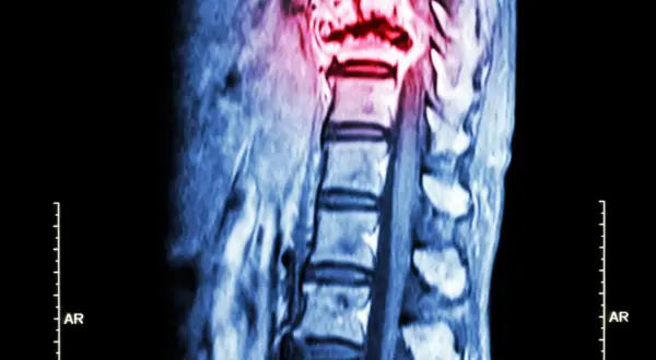 Czy to przerzuty do kości? Objawy i wczesna diagnoza