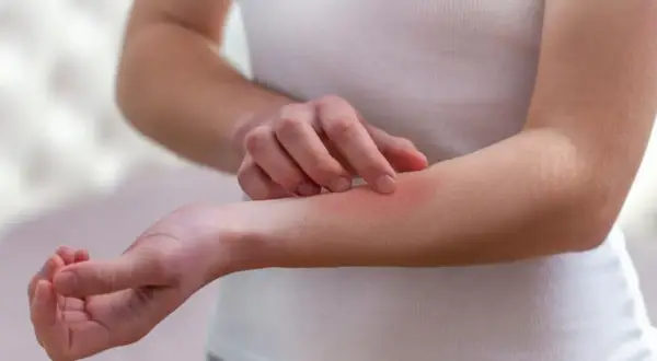 Ręka z zaczerwienioną skórą, która swędzi. Może to być objaw choroby autoimmunologicznej, takiej jak lupus.
