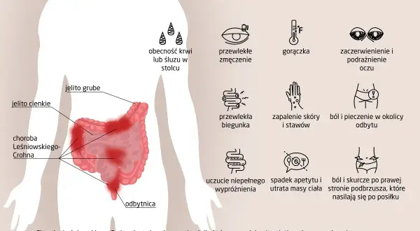 Objawy choroby Leśniowskiego-Crohna: krew w stolcu, zmęczenie, gorączka, zaczerwienienie oczu, biegunka, bóle brzucha, zapalenie skóry i stawów.