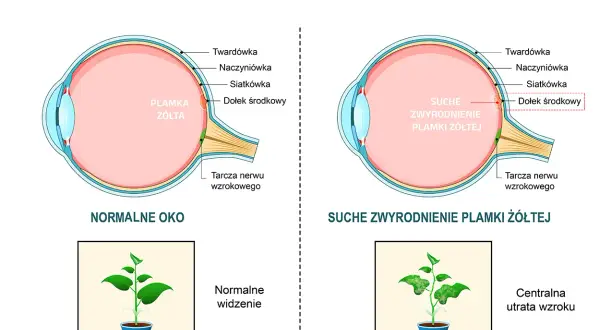Porównanie zdrowego oka z suchym zwyrodnieniem plamki żółtej. W chorym oku plamka żółta jest uszkodzona, co prowadzi do centralnej utraty wzroku, jak na obrazku rośliny.