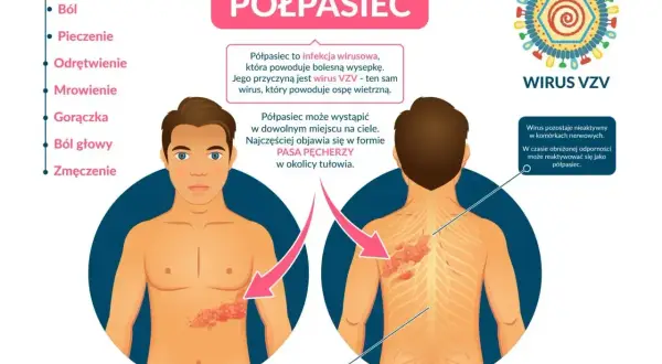 Infografika o półpaścu, jego objawach i wirusie VZV. Pokazuje wykwity skórne na tułowiu, sugerując potrzebę leczenia.