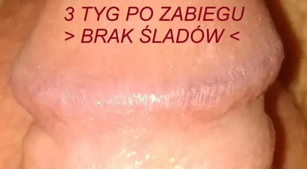 Skóra po zabiegu, gładka, bez śladów, jak perliste grudki.