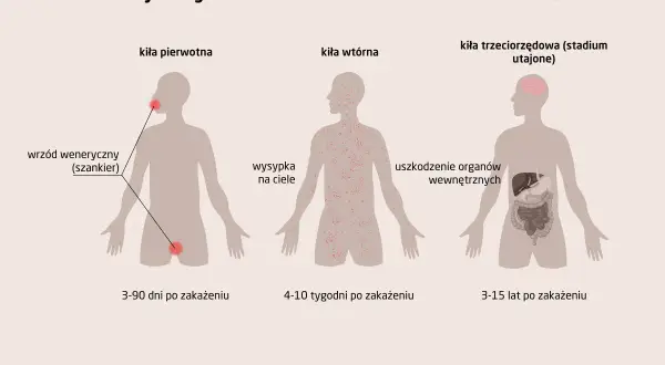 Ilustracja przedstawia stadia rozwoju kiły: pierwotna (wrzód), wtórna (wysypka) i utajona (uszkodzenie narządów).