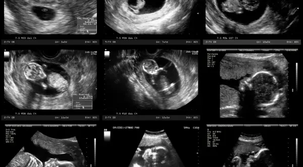 Jak wyglądają badania prenatalne w 12 tyg. ciąży? Rozwiej obawy!