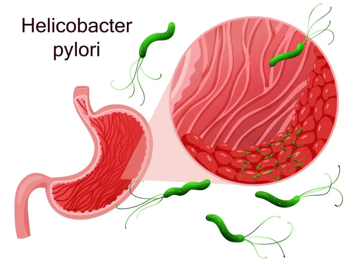 Grafika przedstawia żołądek i powiększony fragment jego błony śluzowej z bakteriami Helicobacter pylori. Skuteczne helicobacter pylori leczenie jest kluczowe.