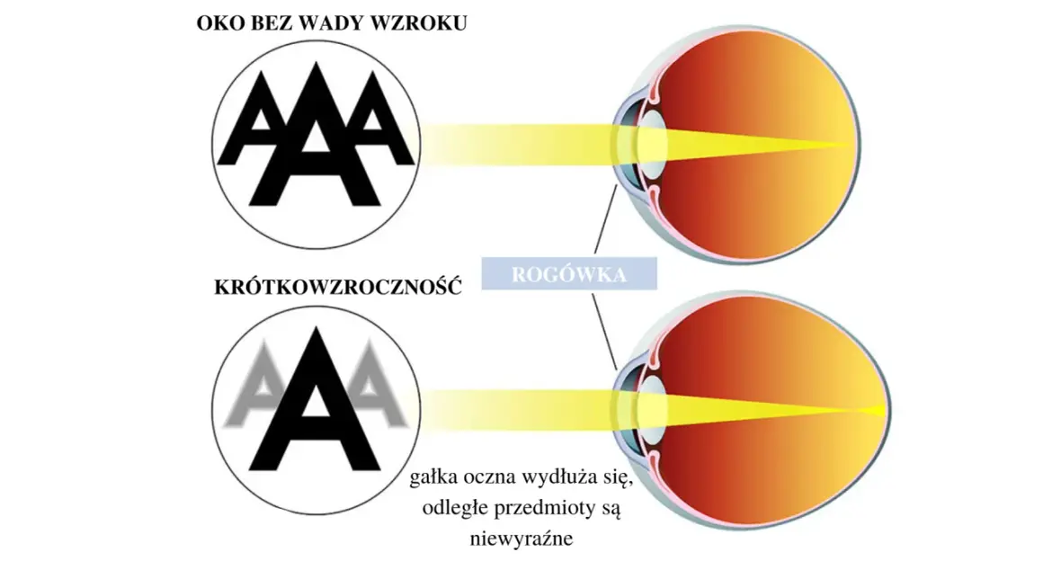 Oko z krótkowzrocznością pokazuje, jak wydłużona gałka oczna powoduje niewyraźne widzenie odległych przedmiotów, w przeciwieństwie do oka bez wady.