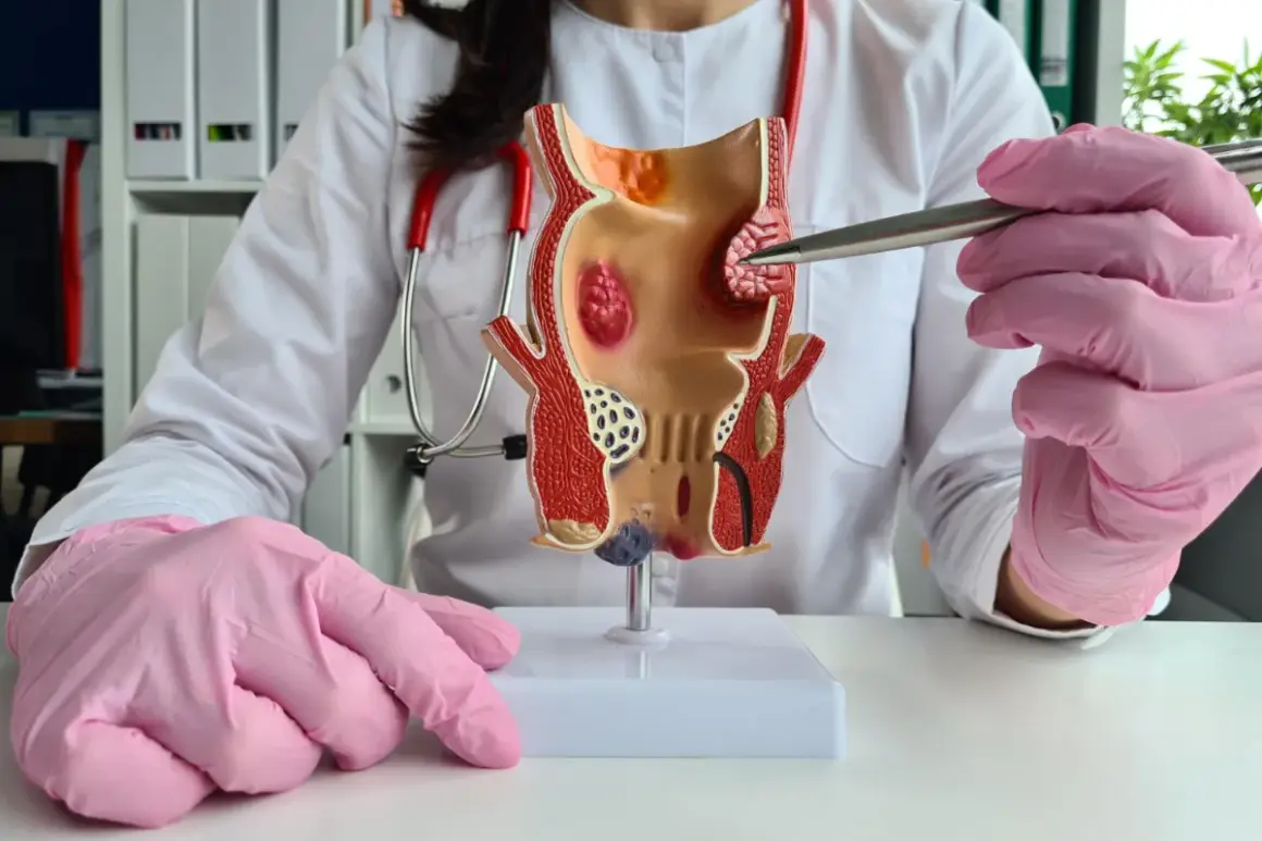 Model jelita grubego z widocznymi zmianami, wskazującymi na hemoroidy zewnętrzne.