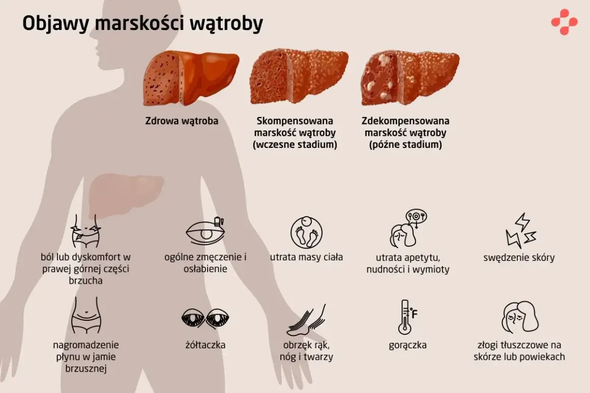 Marskość wątroby: Objawy końcowego stadium co musisz wiedzieć?