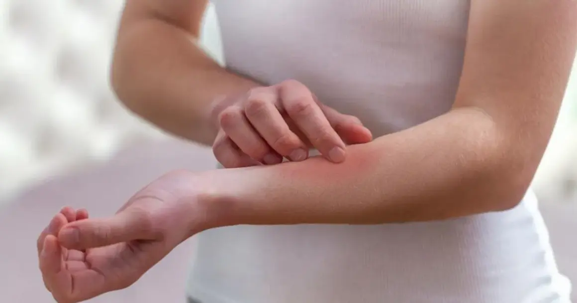 Ręka z zaczerwienioną skórą, która swędzi. Może to być objaw choroby autoimmunologicznej, takiej jak lupus.