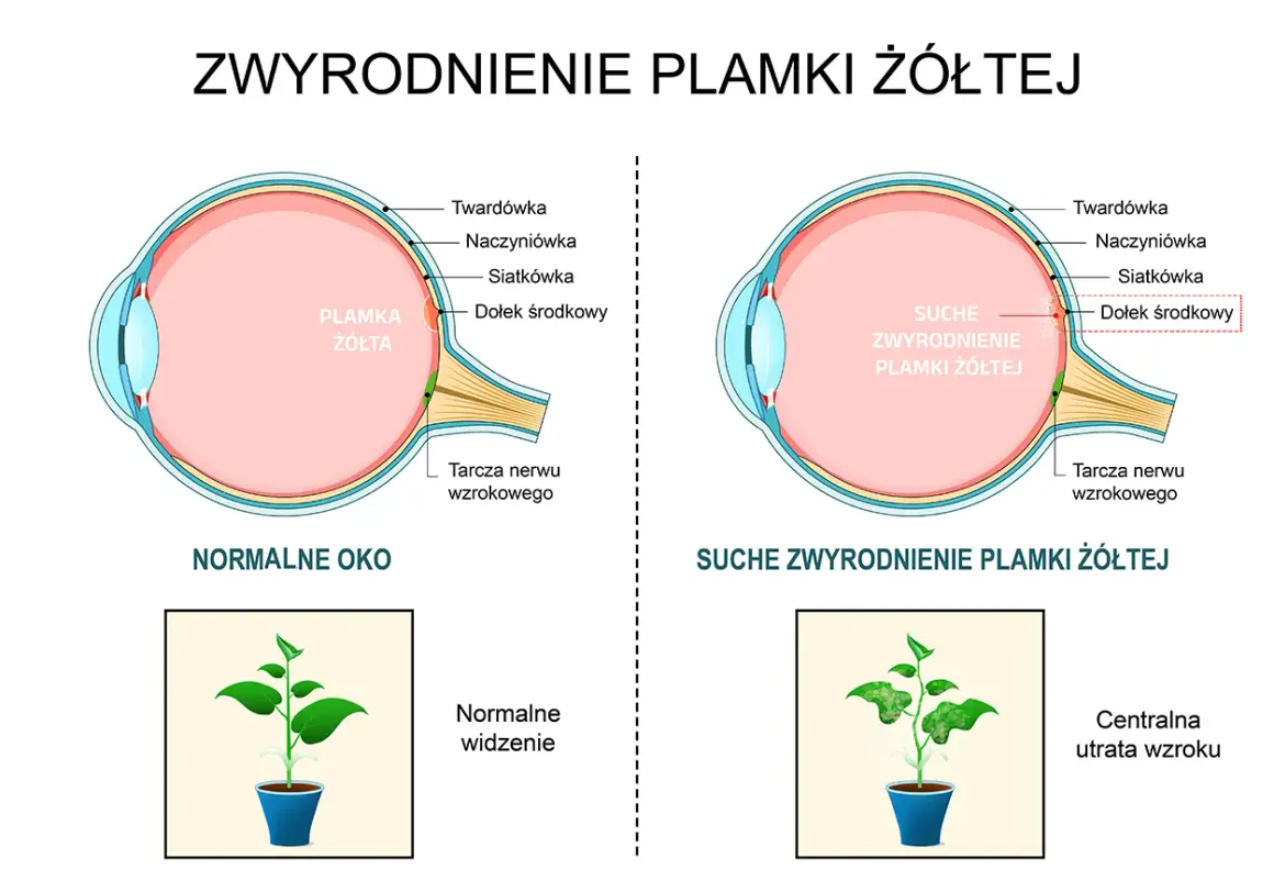 Porównanie zdrowego oka z suchym zwyrodnieniem plamki żółtej. W chorym oku plamka żółta jest uszkodzona, co prowadzi do centralnej utraty wzroku, jak na obrazku rośliny.