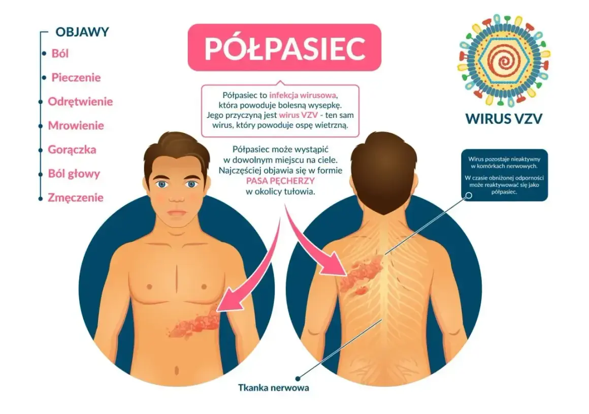Infografika o półpaścu, jego objawach i wirusie VZV. Pokazuje wykwity skórne na tułowiu, sugerując potrzebę leczenia.