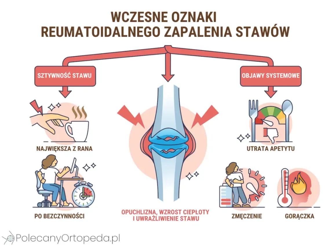 Wczesne objawy reumatyzmu: sztywność stawów, opuchlizna, zmęczenie, utrata apetytu i gorączka.