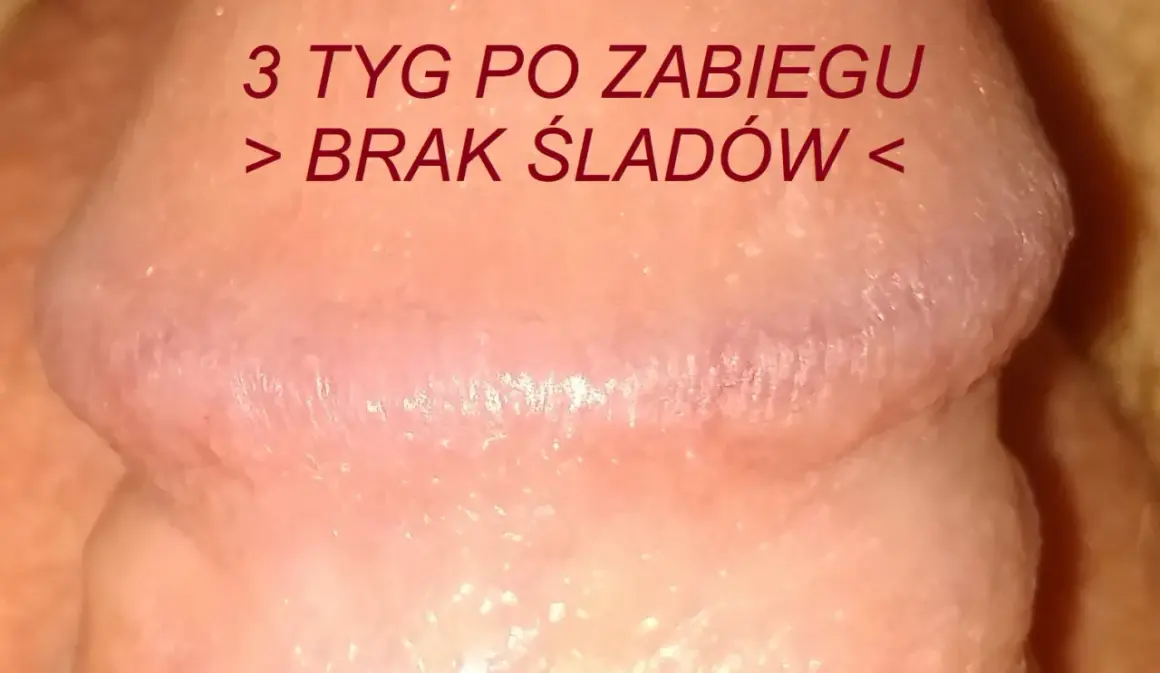 Skóra po zabiegu, gładka, bez śladów, jak perliste grudki.