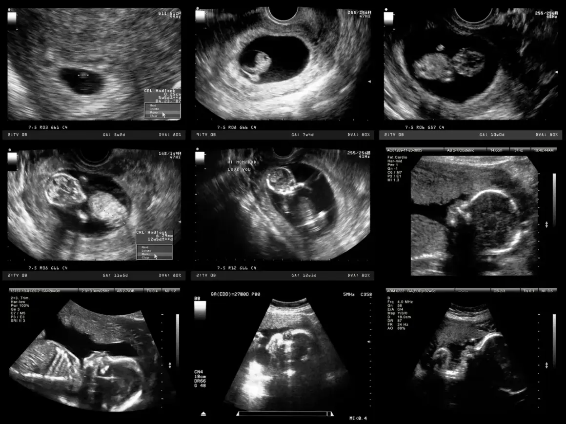 Jak wyglądają badania prenatalne w 12 tyg. ciąży? Rozwiej obawy!