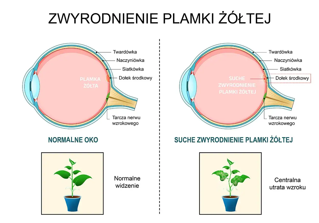 Porównanie budowy oka zdrowego i zmagającego się z suchym zwyrodnieniem plamki żółtej. Obrazek pokazuje, jak choroba wpływa na widzenie, porównując normalne widzenie rośliny do centralnej utraty wzroku.