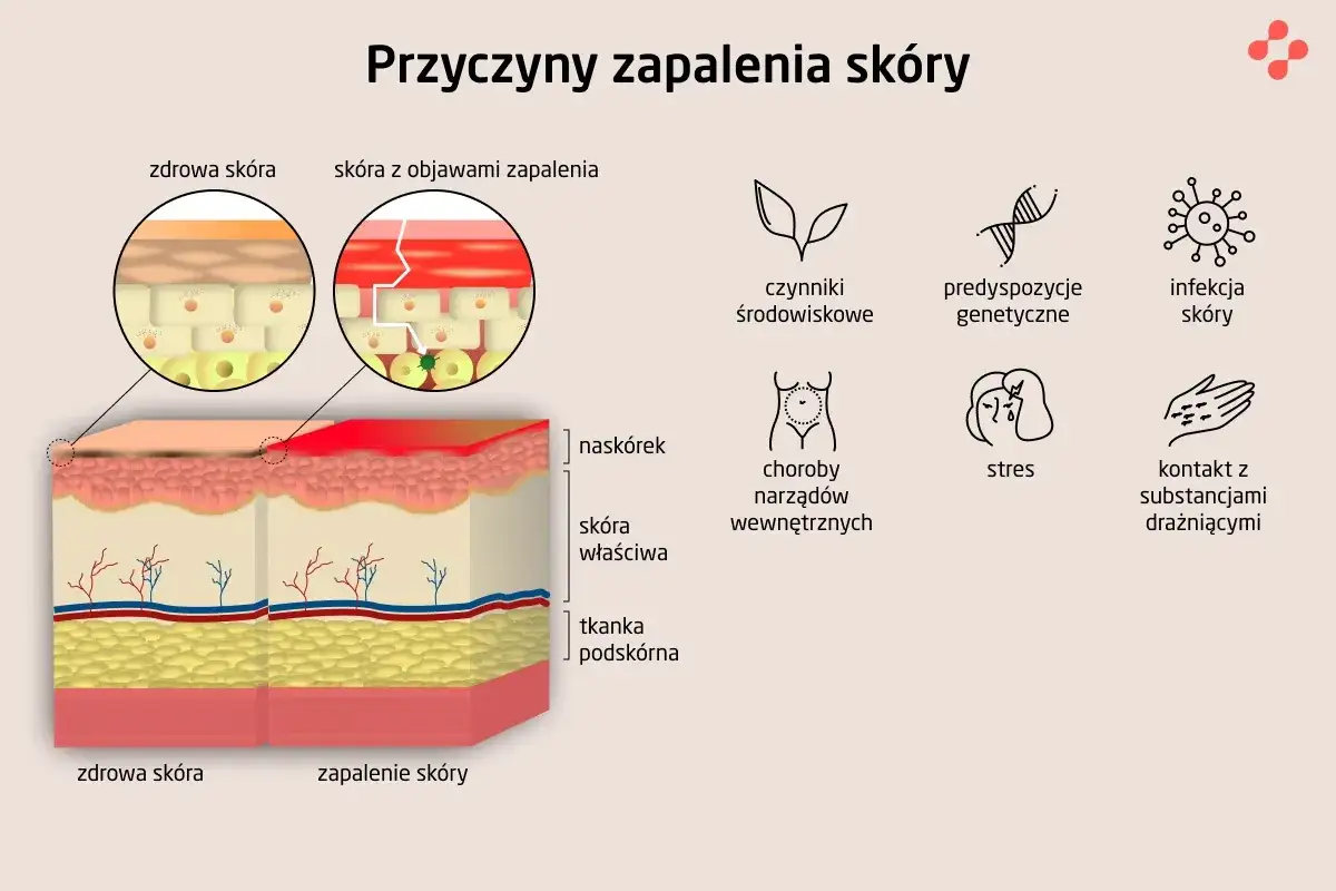 genetyczne podłoże atopowego zapalenia skóry