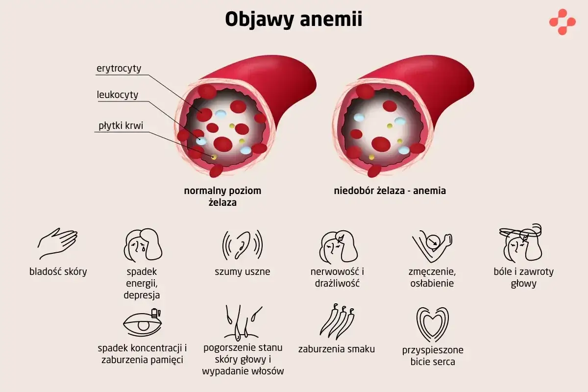 Ilustracja pokazuje naczynie krwionośne z normalnym poziomem żelaza i z niedoborem żelaza (anemia). Objawy anemii to m.in. bladość skóry, zmęczenie, bóle głowy.