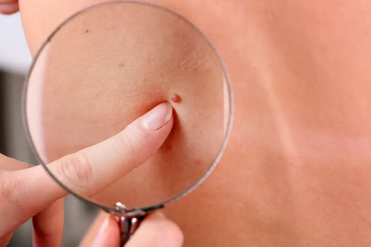 Dermatoskopia: palec wskazujący bada pieprzyk pod lupą.