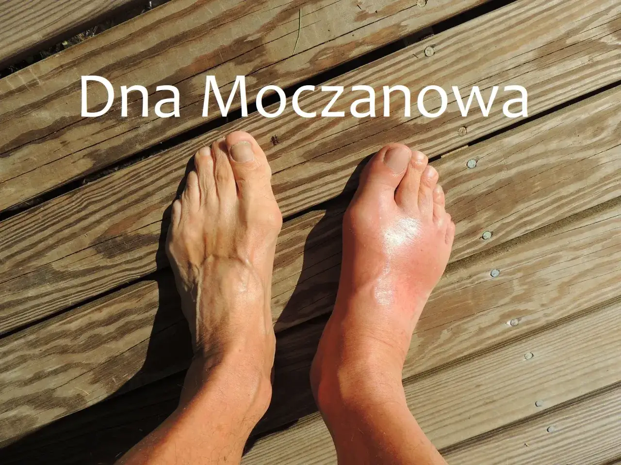Dna moczanowa przyczyny infografika