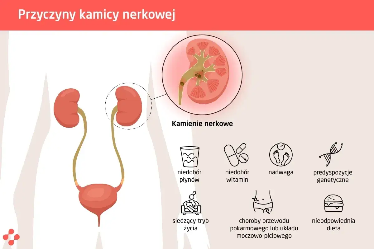 Ilustracja przedstawia przyczyny kamicy nerkowej: kamienie w nerce, niedobór płynów, witamin, siedzący tryb życia, nadwagę, choroby układu pokarmowego i moczowo-płciowego, predyspozycje genetyczne i nieodpowiednią dietę.