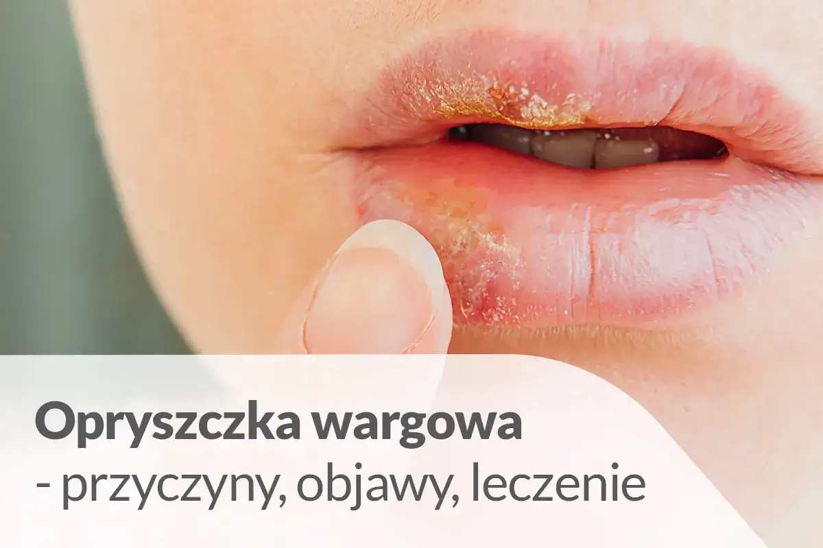 Opryszczka wargowa, która pojawiła się nagle, może być uciążliwa. Szukasz sposobu na opryszczkę w 1 dzień?