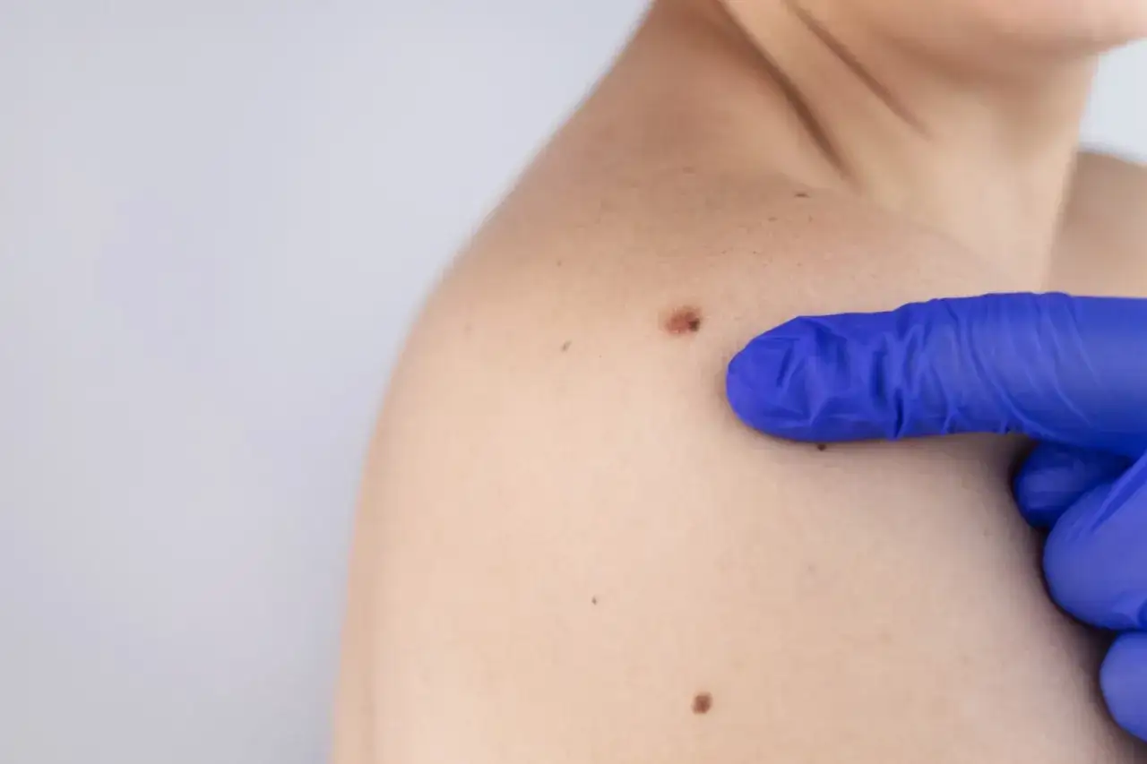 Dłoń w niebieskiej rękawiczce wskazuje na pieprzyk na ramieniu podczas badania dermatoskopia.