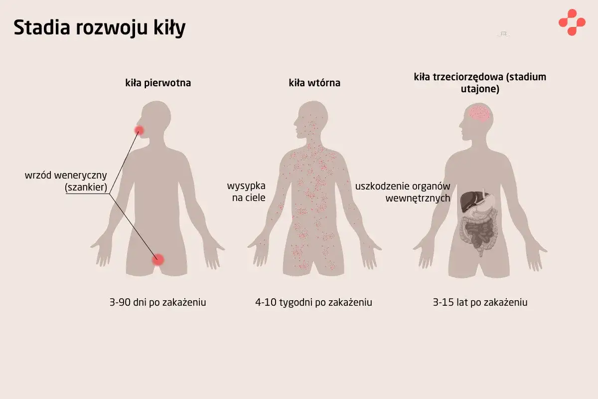 Ilustracja przedstawia stadia rozwoju kiły: pierwotna (wrzód), wtórna (wysypka) i utajona (uszkodzenie narządów).