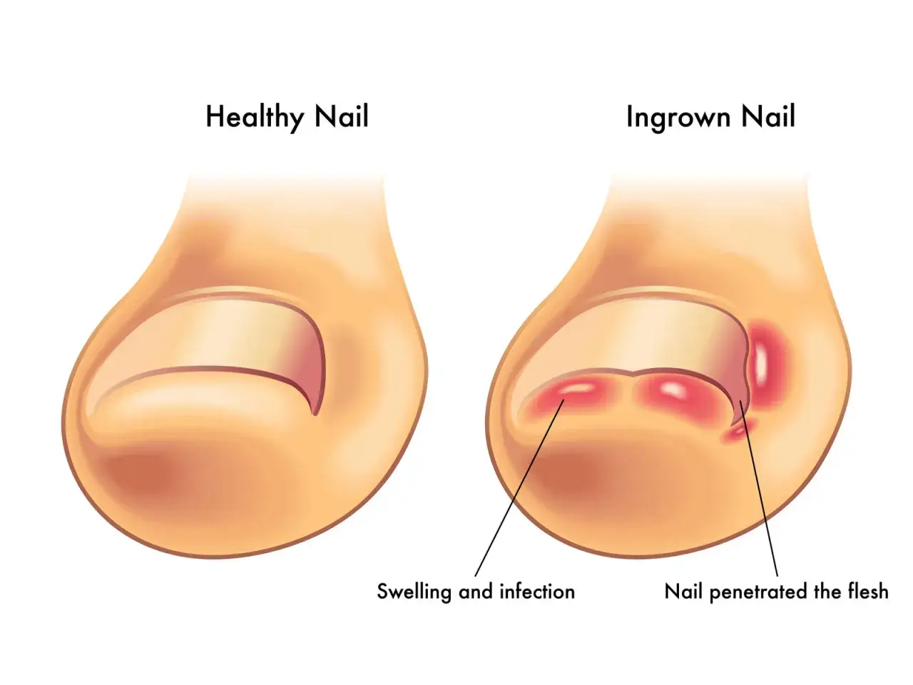 Zdrowy paznokieć obok palca z wrastającym paznokciem, obrzękiem i infekcją.