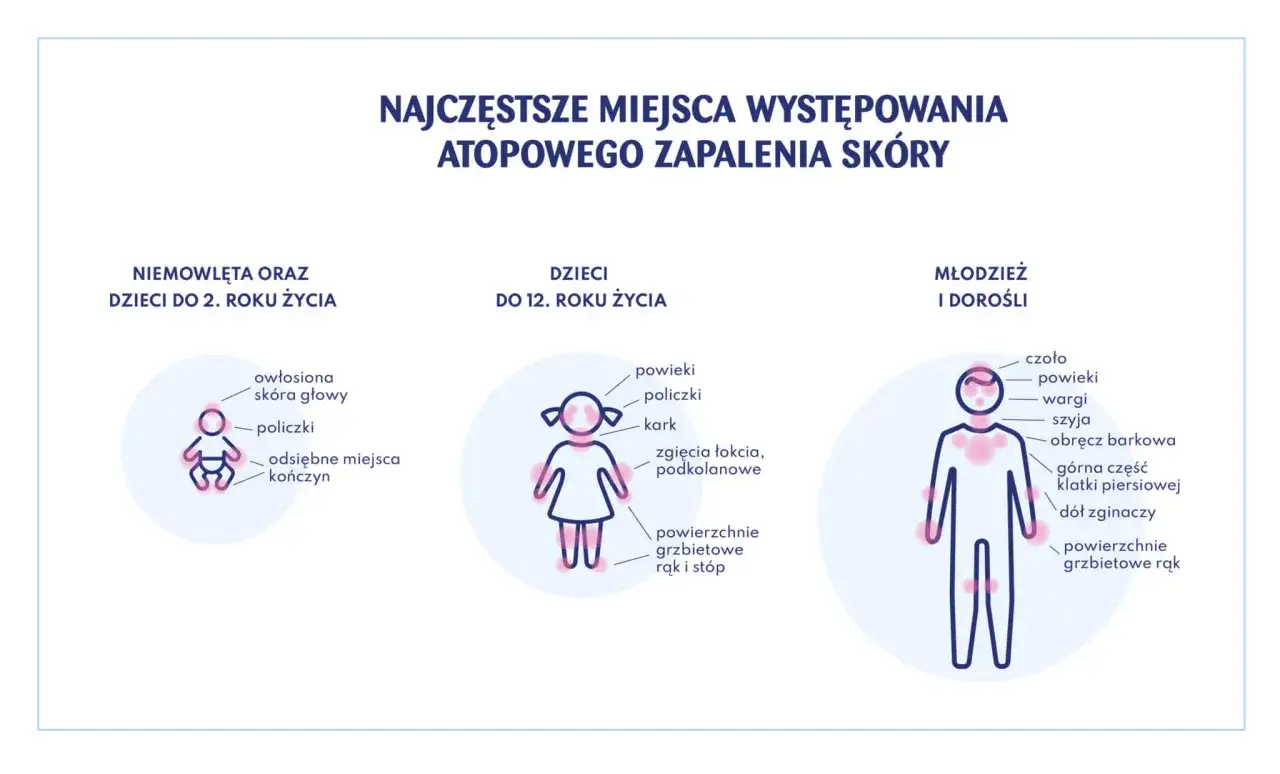Skóra atopowa mikroskop, gen filagryny