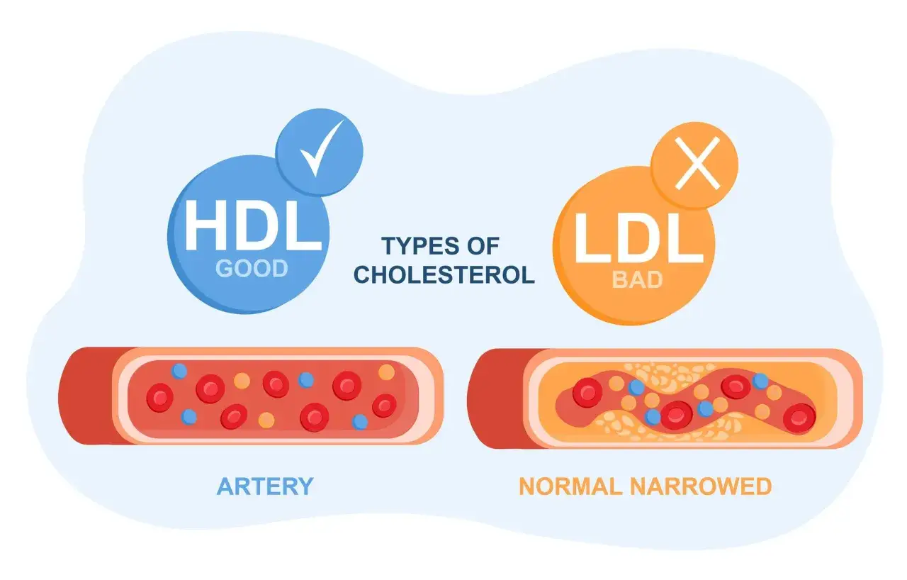 Porównanie tętnicy z prawidłowym przepływem (HDL) i zwężonej przez zły cholesterol (LDL). Grofibrat pomaga obniżyć poziom LDL.