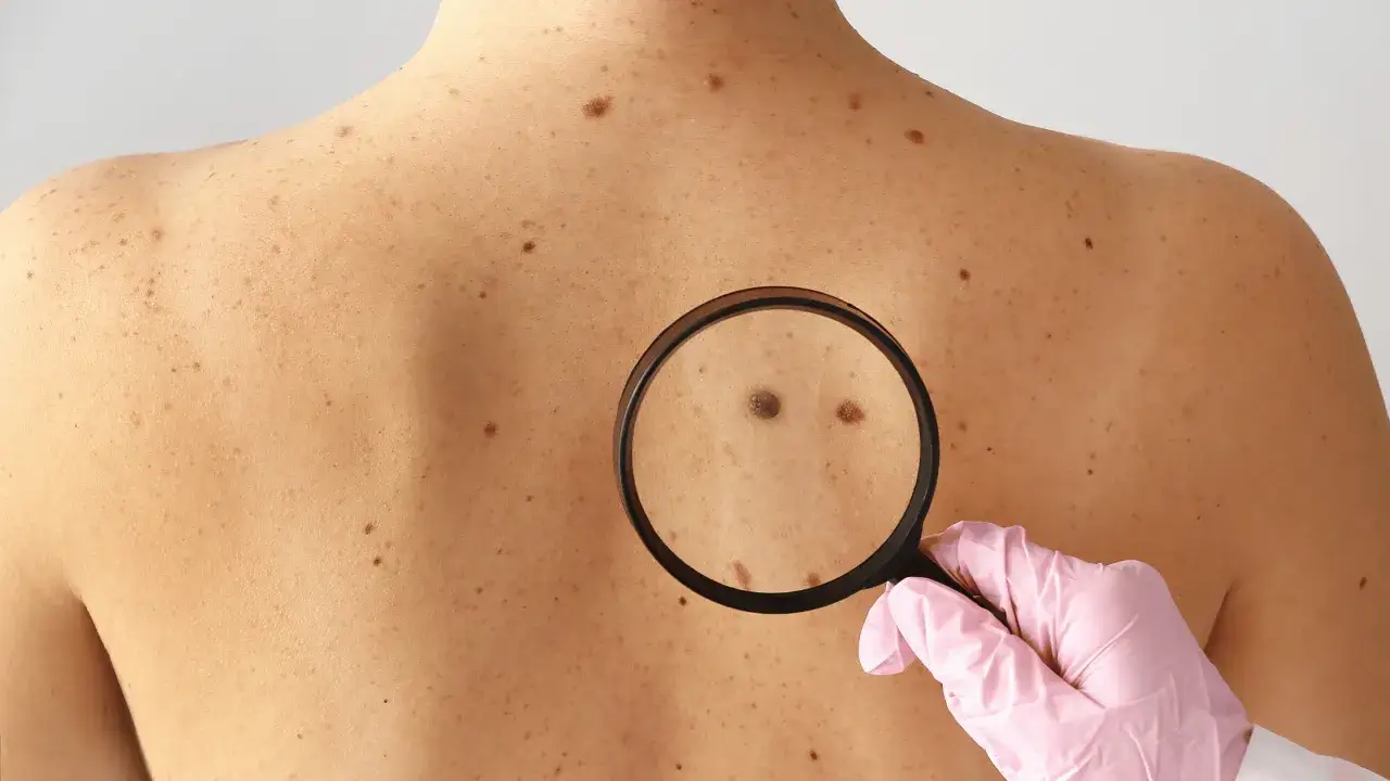Dermatoskopia badanie znamion