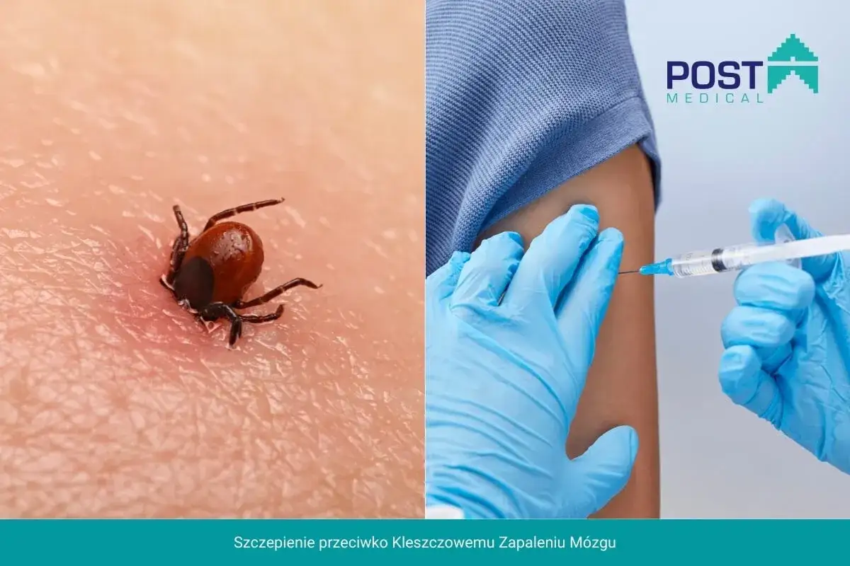 Kleszcz wbija się w skórę, a obok ręka w niebieskiej rękawiczce podaje szczepionkę przeciw kleszczowemu zapaleniu mózgu.