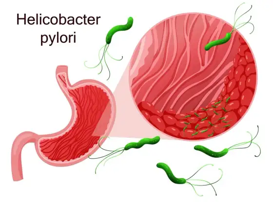 Helicobacter pylori - jakie leczenie działa w Polsce?