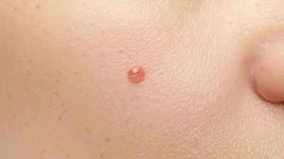 Dermatoskopia - Czy Twój pieprzyk jest bezpieczny? Sprawdź!