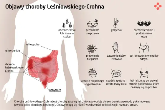 Choroba Crohna - objawy, diagnostyka i leczenie