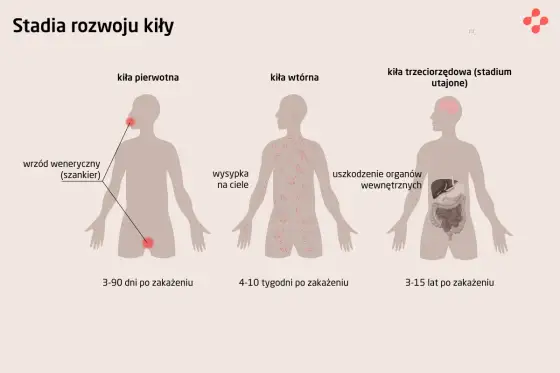 Kiła - objawy, leczenie i profilaktyka. Nie czekaj na ból!
