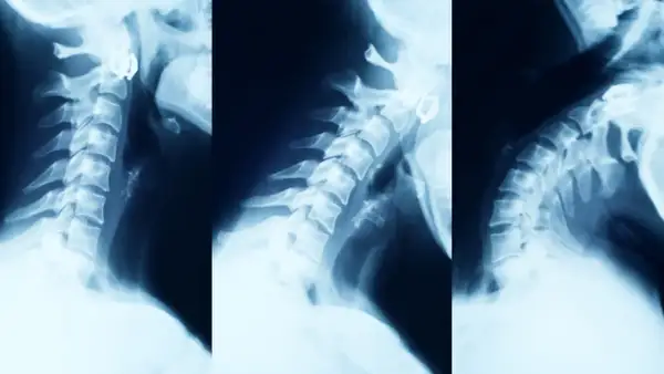 Objawy neurologiczne zwyrodnienia kręgosłupa: Kiedy do lekarza?