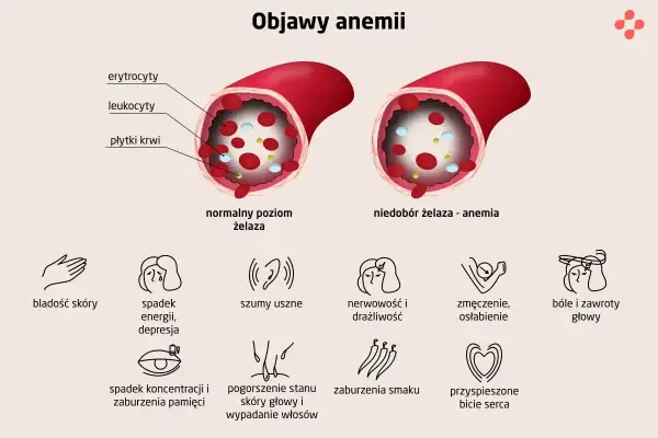 Ilustracja pokazuje, co to jest anemia: porównanie poziomu żelaza we krwi i objawy, takie jak bladość, zmęczenie, bóle głowy.