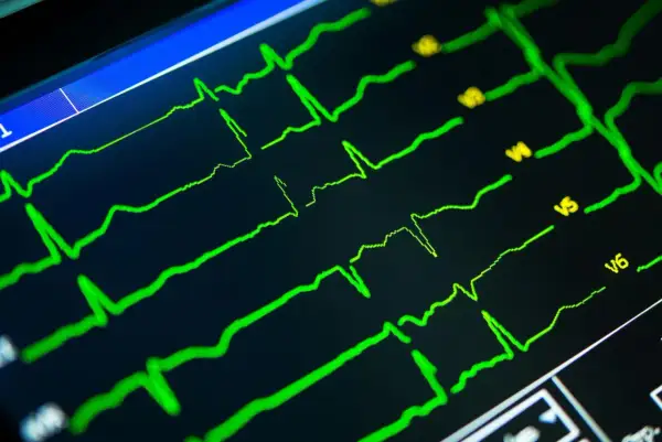 Twój wynik EKG: Obniżenie odcinka ST co to znaczy?