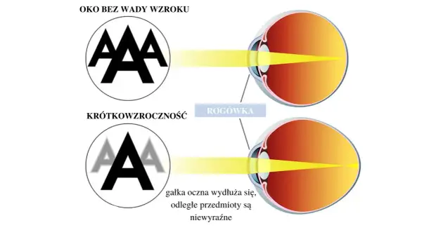 Oko z krótkowzrocznością pokazuje, jak wydłużona gałka oczna powoduje niewyraźne widzenie odległych przedmiotów, w przeciwieństwie do oka bez wady.