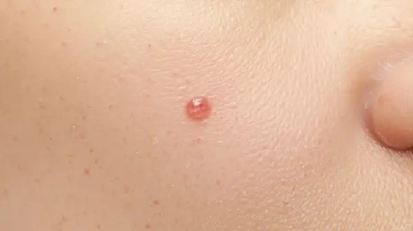 Zbliżenie na skórę z widocznym pieprzykiem, idealne do analizy podczas dermatoskopii.