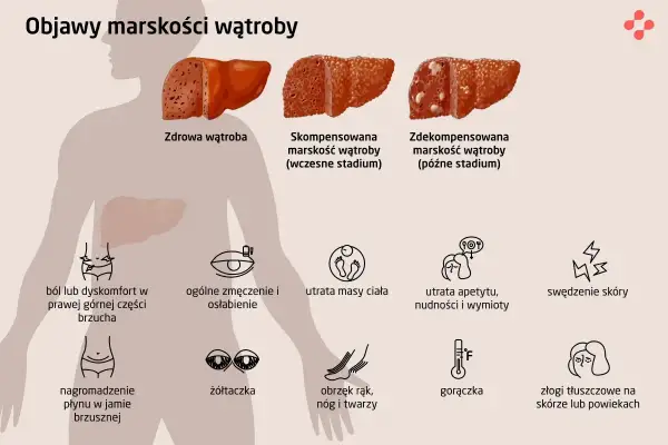 Marskość wątroby: Objawy końcowego stadium co musisz wiedzieć?