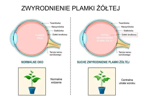 Porównanie zdrowego oka z suchym zwyrodnieniem plamki żółtej. W chorym oku plamka żółta jest uszkodzona, co prowadzi do centralnej utraty wzroku, jak na obrazku rośliny.