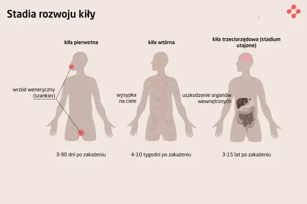 Ilustracja przedstawia stadia rozwoju kiły: pierwotna (wrzód), wtórna (wysypka) i utajona (uszkodzenie narządów).