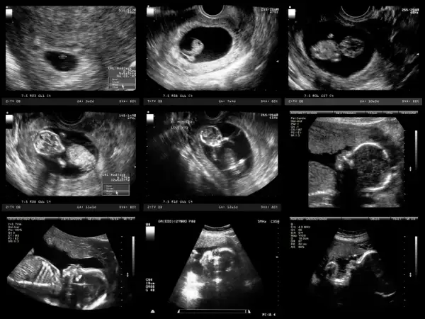 Jak wyglądają badania prenatalne w 12 tyg. ciąży? Rozwiej obawy!